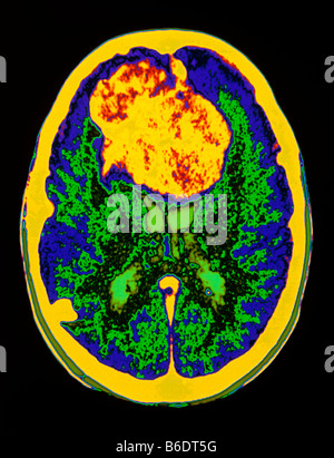 Meningeom. Farbige magnetische Resonanceimaging (MRI)-Gehirn-Scan zeigt ein Meningeom, ein gutartiger Tumor (nicht bösartig). Stockfoto