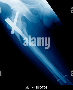 Angeheftete gebrochenes Bein farbig x-ray. Der Patient Femur (Oberschenkelknochen) hat chirurgisch immobilisiert. Stockfoto