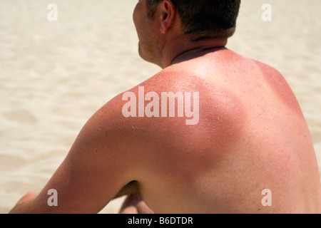 Mann mit sonnenverbrannten Schultern sitzen am Strand. Sonnenbrand wird durch übermäßige Sonneneinstrahlung verursacht. Stockfoto