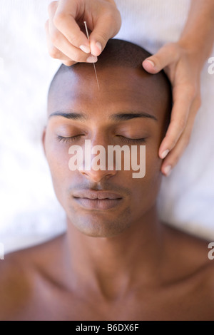 Einfügen einer Nadel in Patienten Stirn Akupunkteur Stockfoto