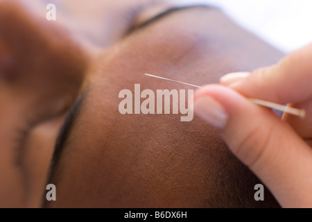 Acupuncturistinserting eine Nadel in Patienten Stirn Stockfoto