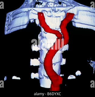 3 dimensionale Falschfarbenbild der Division der Bauchschlagader in den Iliacarteries aus CT-Scandaten zusammengestellt. Stockfoto