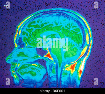 Kernresonanzspektroskopie (NMR) Bild von einer Mitte sagittaler Schnitt durch einen menschlichen Kopf. Stockfoto