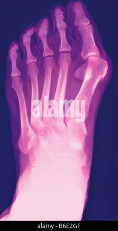 Hallux valgus. Farbig x-ray ein Ballen (Hallux valgus, oben rechts), die Schwellung des Gelenks. Stockfoto