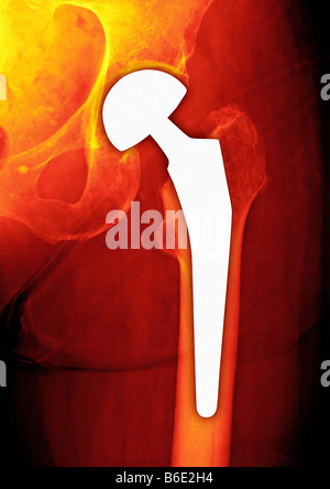 Hüftgelenkersatz. Farbige frontale Röntgenaufnahme des weiblichen Beckens mit einem Hüftgelenkersatz (weiß, unten rechts). Stockfoto