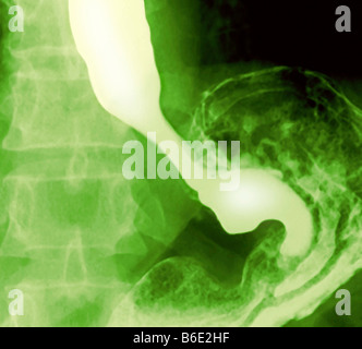 Normale Speiseröhre und Magen. Farbige FrontalX-Ray eine gesunde Speiseröhre (oben links) Andstomach (unten rechts). Stockfoto