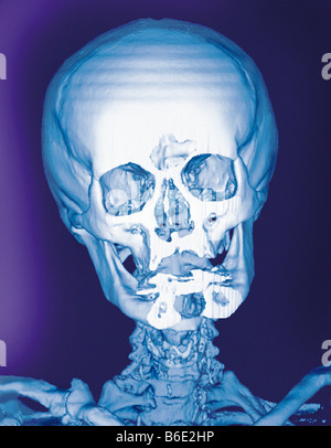 Normale Schädel farbig frontalen 3D Computertomographie (CT) Scan. Stockfoto