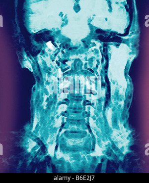 Normaler Kopf und Hals, farbige koronalen Magneticresonance Bildgebung (MRT). Stockfoto
