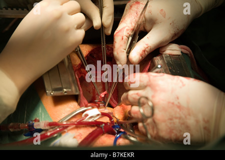 Herz-Chirurgie, CABG, Aorto-koronarer Bypass Stockfoto