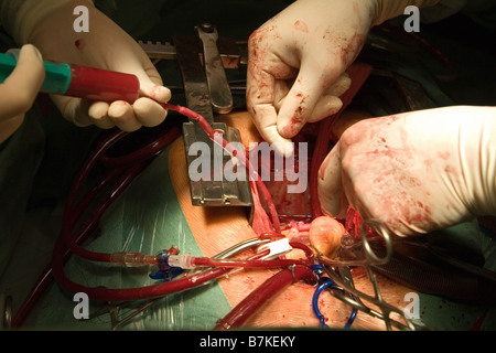 Herz-Chirurgie, CABG, Aorto-koronarer Bypass Stockfoto