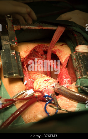 Herz-Chirurgie, CABG, Aorto-koronarer Bypass Stockfoto