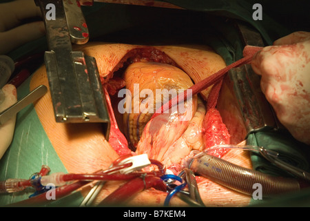 Herz-Chirurgie, CABG, Aorto-koronarer Bypass Stockfoto