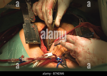 Herz-Chirurgie, CABG, Aorto-koronarer Bypass Stockfoto