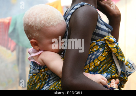 Albino-Mädchen in Sierra Leone, Afrika, auf der Rückseite ihrer Schwester Stockfoto