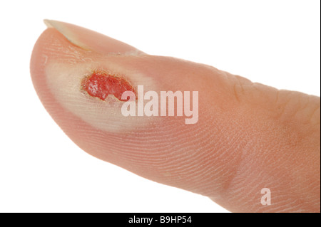 Zweiten Grades verbrannten Finger mit einem durchbohrten brennen blister auf der Epidermis und papillären Schicht (Stratum Papillare) zerstört Stockfoto