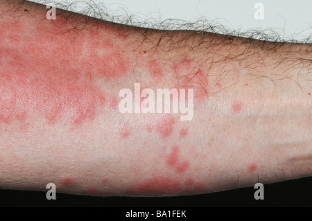 Nahaufnahme von Hautausschlag am Arm aus portugiesischer Mann o Krieg (Physalia Physalis), auch bekannt als die blaue Blase, blaue Flasche, Kriegsschiff Stockfoto