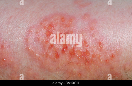 Nahaufnahme von Hautausschlag am Arm aus portugiesischer Mann o Krieg (Physalia Physalis), auch bekannt als die blaue Blase, blaue Flasche, Kriegsschiff Stockfoto