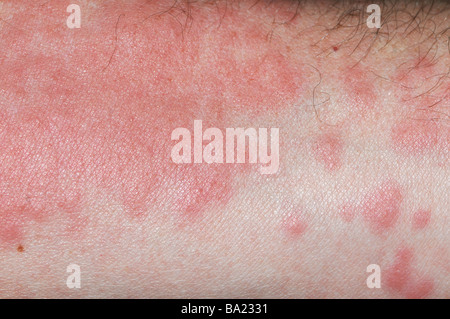 Nahaufnahme von Hautausschlag am Arm aus portugiesischer Mann o Krieg (Physalia Physalis), auch bekannt als die blaue Blase, blaue Flasche, Kriegsschiff Stockfoto