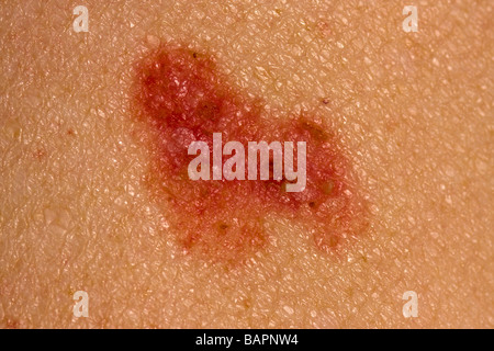 Basalzell-Karzinom Stockfoto