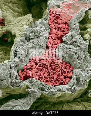 Blutgefäße in der Lunge, farbige scanning Electron Schliffbild. Diese kleine Arterie ist gebrochen, um geschlossene rote Bloodcells zeigen Stockfoto