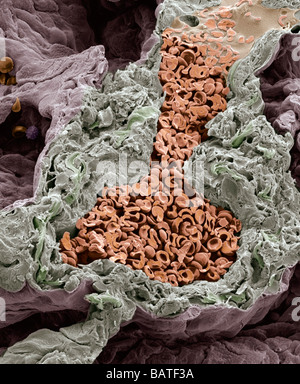 Blutgefäße in der Lunge, farbige scanning Electron Schliffbild. Diese kleine Arterie ist gebrochen, um geschlossene rote Bloodcells zeigen Stockfoto