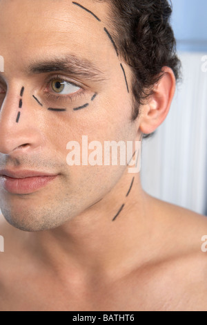 Kosmetische Chirurgie. Patient mit Markierungen auf seinem Gesicht in Vorbereitung für kosmetische Chirurgie. Stockfoto