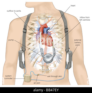 -Ventricular Assist Device, ein künstliches Herz, das Pumpe hilft oxydierten Blut durch die Aorta und Gewebe des Körpers. Stockfoto