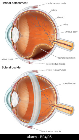 Diagramm der skleralen Schnalle, verwendet um eine Netzhautablösung zu reparieren. Stockfoto