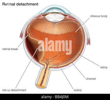 Schematische Darstellung einer Netzhautablösung. Stockfoto