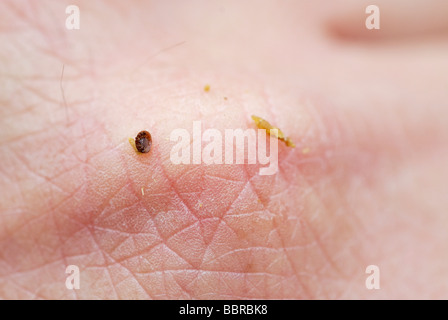 Toten Destruktor Varroamilbe (Varroa Destructor Varroa Jacobsoni) auf der Rückseite des jemandes hand Stockfoto