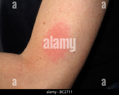 Gürtelrose-Impfstoff Reaktion auf Erwachsenen weiblichen Arm. Stockfoto