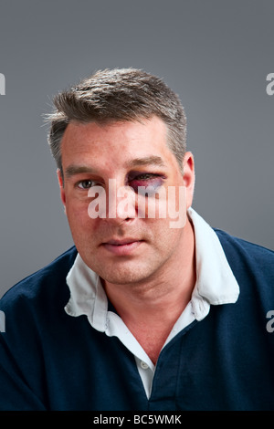 Porträt von einem kaukasischen Mann mit gequetschten blauen Auge Stockfoto