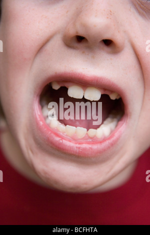 Nahaufnahme eines siebenjährigen Kindes Mund mit fehlenden Zähnen Stockfoto