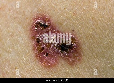 Basalzell-Karzinom Stockfoto