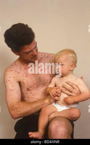 Vater bedeckt mit akuten Windpocken, der sein Baby mit nur wenigen Flecken hält Stockfoto