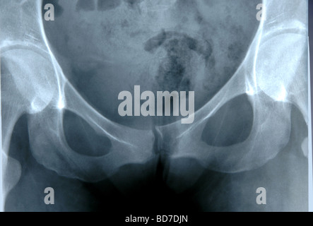 X-Ray des menschlichen Beckens zeigt Hüftknochen und Bauchbereich Stockfoto