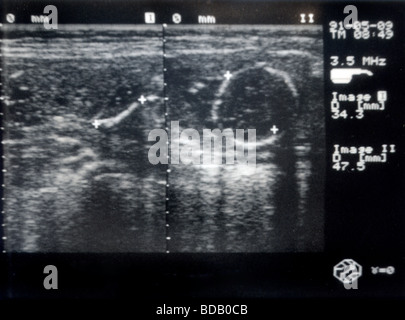 Ultraschall Schwangerschaft Stockfoto
