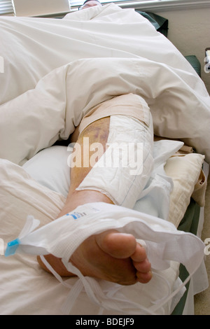 Postoperative Fotos eines Patienten nach einem Mountain-Bike-Unfall erforderlich Ärzte eine Titanplatte in seinem linken Bein Schraube Stockfoto