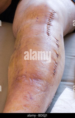 Postoperative Fotos eines Patienten nach einem Mountain-Bike-Unfall erforderlich Ärzte eine Titanplatte in seinem linken Bein Schraube Stockfoto