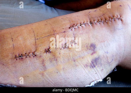 Postoperative Fotos eines Patienten nach einem Mountain-Bike-Unfall erforderlich Ärzte eine Titanplatte in seinem linken Bein Schraube Stockfoto