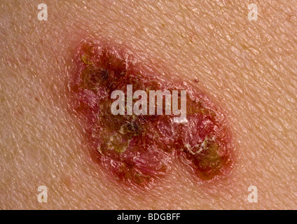 Basalzell-Karzinom Stockfoto