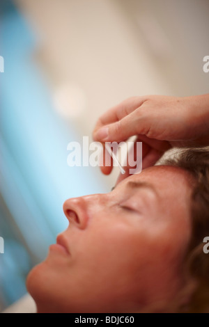 Frau empfangen Akupunktur Stockfoto