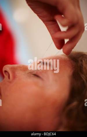 Frau empfangen Akupunktur Stockfoto