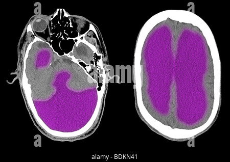 CT-Scan-Bilder aus ein 67 Jahre alter Mann mit schweren ein Hydrozephalus Stockfoto