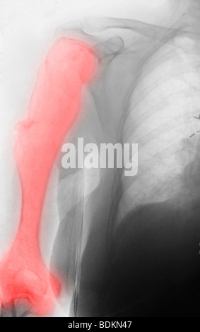 76 jährige Frau mit angeborene Fehlbildungen des humerus Stockfoto