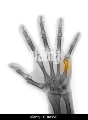 x-ray zeigt eine heilende Boxer Fraktur in ein 56 Jahre alter Mann Stockfoto