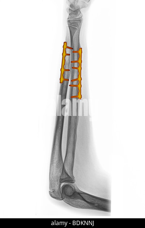 Röntgen des Unterarms eines 14 Jahre alten Jungen mit Metallplatten und Schrauben verwendet, um seine gebrochene Speiche und Elle reparieren Stockfoto