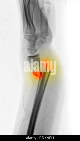 x-ray zeigt einen stark Vertriebenen Radius und Ulna Unterarm Bruch in ein 12 Jahre altes Mädchen Stockfoto