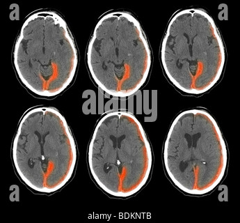 CT-Scan des Gehirns ein 73 Jahre alter Mann zeigen intrakraniellen Blutungen Stockfoto