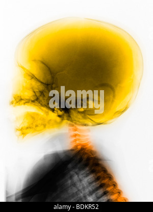 Normale Schädel Röntgen eines 6 Monate alten Jungen Stockfoto